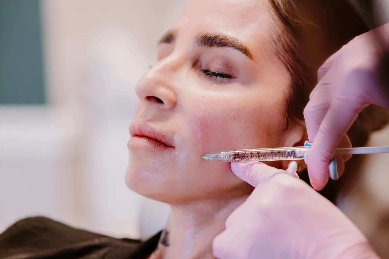 Close-up of a dermal filler treatment to the cheek